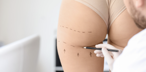 Best Liposuction Results
