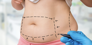 Liposuction Cost Near Annandale