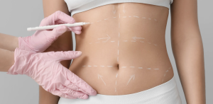 Tummy Tuck Costs in Northern Virginia