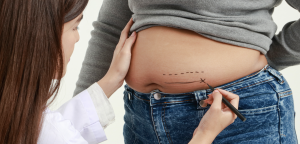 Liposuction Pricing in Fairfax