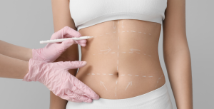 Liposuction Surgeon and Costs in Alexandria