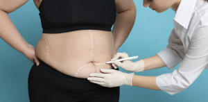 360 Liposuction Surgery Provider and Cost