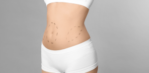 Affordable Liposuction in Arlington