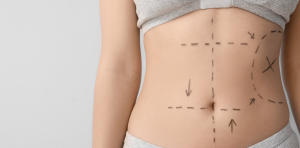 Affordable Liposuction Clinic in Arlington