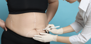 Cost-Effective Liposuction Options Available in Fairfax