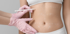 Liposuction Treatments for Residents of Richmond Virginia