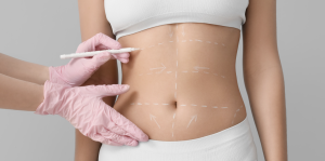 Liposuction Surgery in Reston Virginia