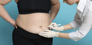 Liposuction Surgery Options in Fairfax Virginia