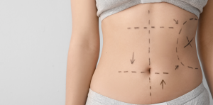 Affordable Liposuction Clinic Near Alexandria