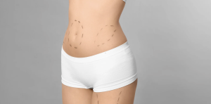 Affordable Liposuction Provider in Centreville