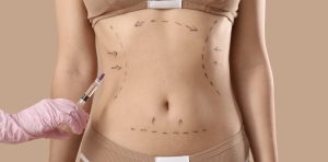 Liposuction Pricing in Alexandria VA