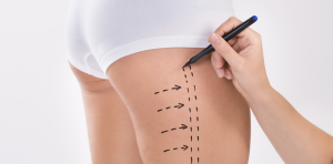 Liposuction Price Ranges in Reston VA