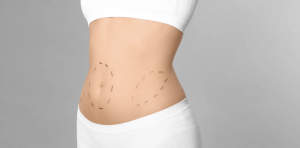 Liposuction Costs in Arlington VA