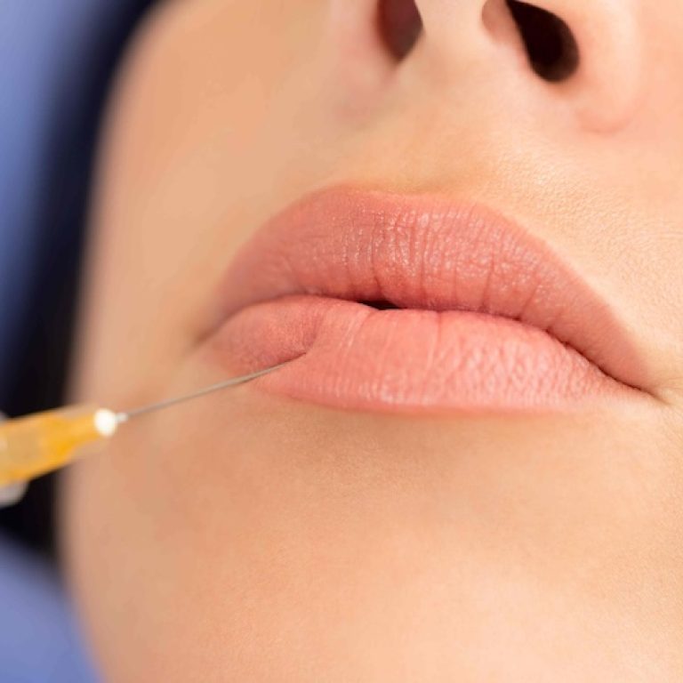 Lip Injections Near McLean VA